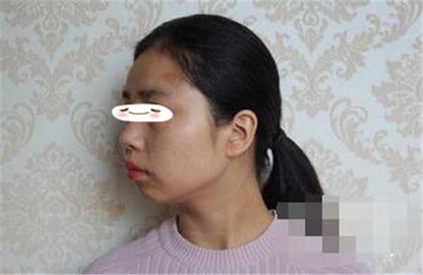王志军抽脂术后果怎么样?案例,价格,口碑