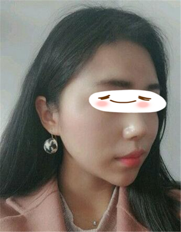 王志军抽脂术后果怎么样?案例,价格,口碑