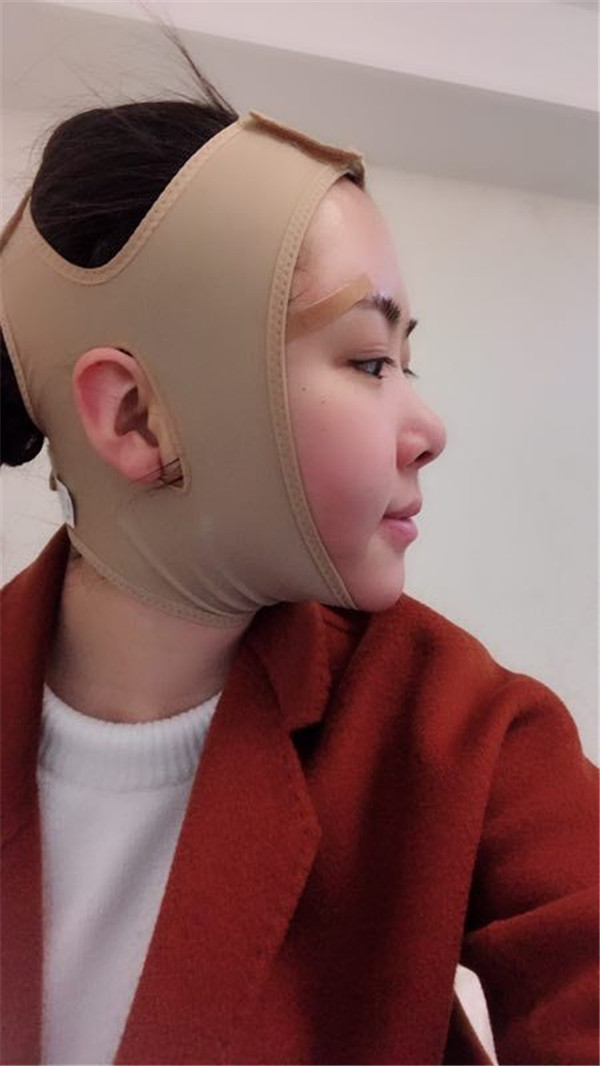 上海华美张朋抽脂术后果怎么样?案例_价格