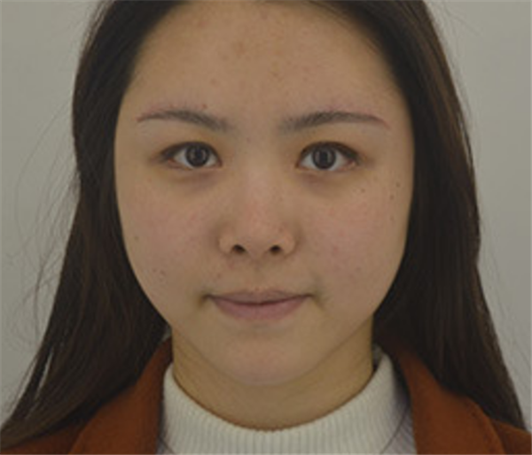 上海华美张朋抽脂术后果怎么样?案例_价格