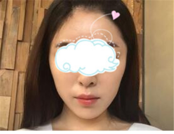 上海玫瑰张东旭抽脂术后果怎么样?案例,价格,口碑