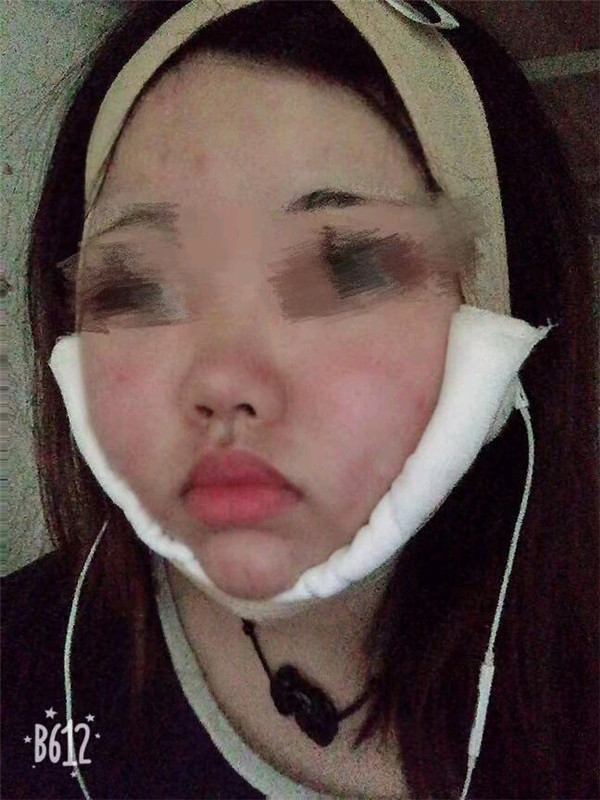 北京韩啸郑京桓抽脂术后果怎么样?案例_价格_口碑