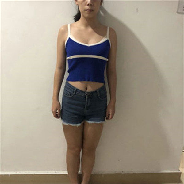 上海华美谢卫国抽脂术后果怎么样?案例_价格_口碑