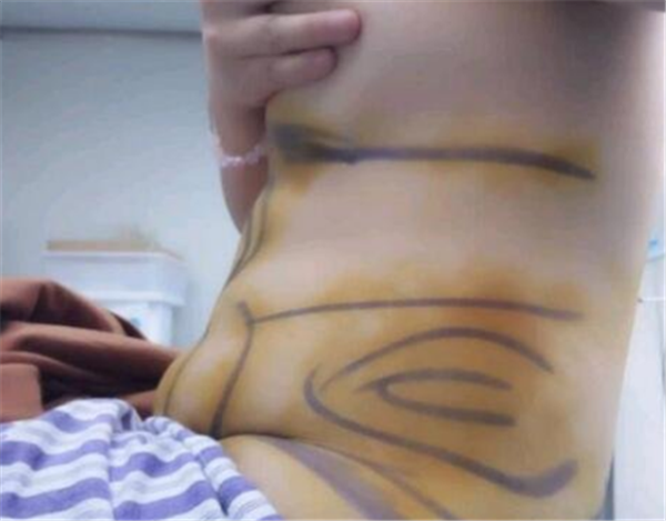 北京禾美嘉韦辉抽脂术后果怎么样?案例_价格