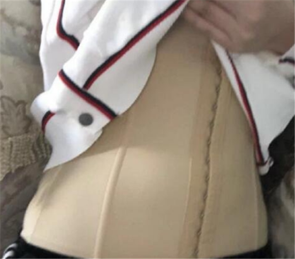 北京禾美嘉韦辉抽脂术后果怎么样?案例_价格
