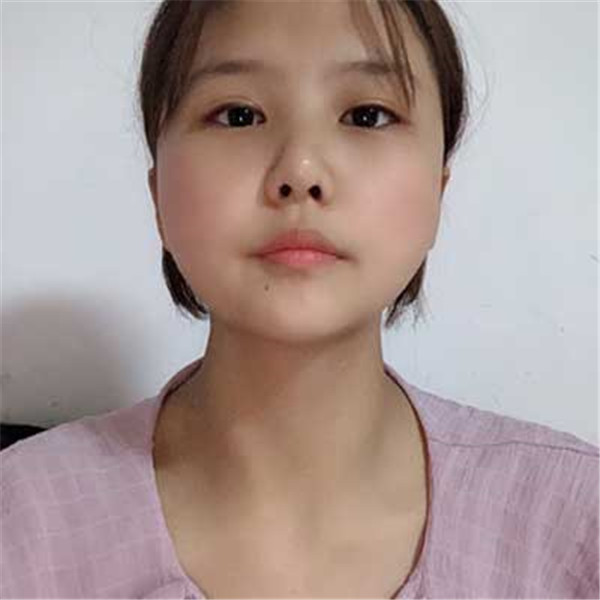 上海华美谢卫国抽脂术后果怎么样?案例,价格
