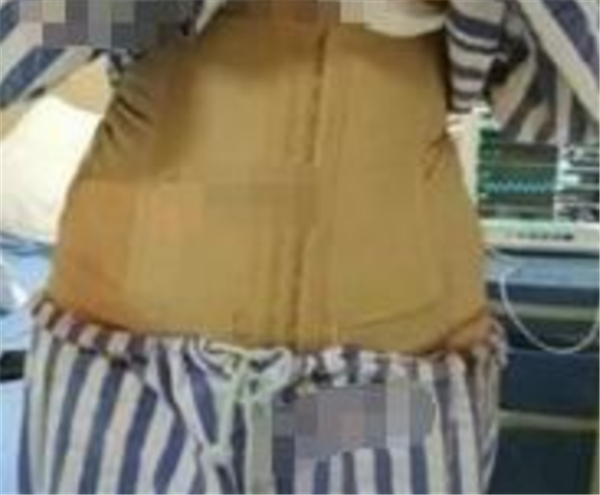 北京清木马梅生抽脂术后果怎么样?案例,价格