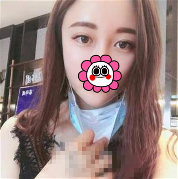 上海华美王荣锡抽脂术后果怎么样?案例,价格,口碑