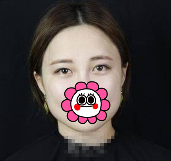上海华美王荣锡抽脂术后果怎么样?案例,价格,口碑