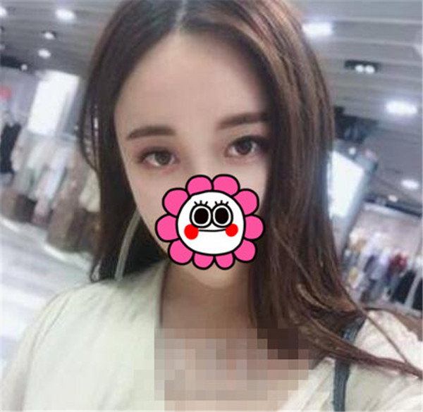上海华美王荣锡抽脂术后果怎么样?案例,价格,口碑