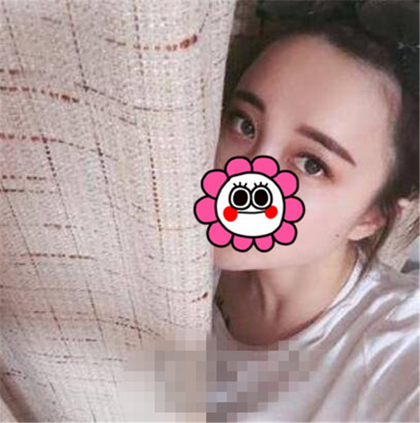 上海华美王荣锡抽脂术后果怎么样?案例,价格,口碑