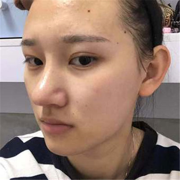 袁玉坤抽脂术后果怎么样?案例,价格,口碑