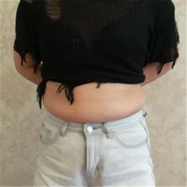 北京玉之光张红芳抽脂术后果怎么样?案例_价格_口碑
