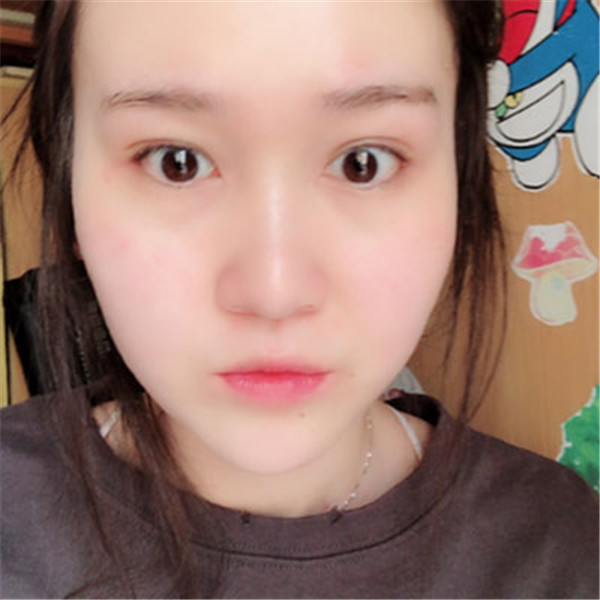 北京玉之光张红芳抽脂术后果怎么样?案例,价格,口碑