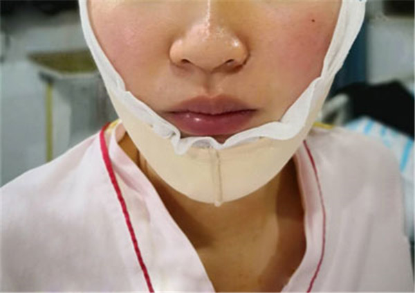 北京玉之光张红芳抽脂术后果怎么样?案例,价格,口碑